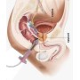 Electrostimulator perineal pentru incontinență Beac IntelliSTIM BE-28UG